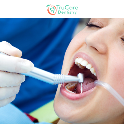 https://www.trucaredentistry.com/blog/wp-content/uploads/5-Major-Types-of-Root-Canal-Treatments.png