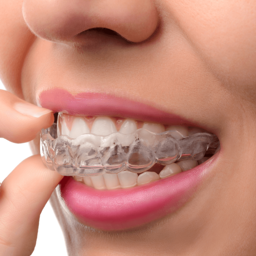 What are the advantages of Invisalign? Can clear-aligners prove better than  metal braces? – TruCare Dentistry