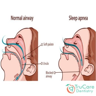 All You Need to Know About Sleep Apnea: A Sleep Disorder – TruCare Dentistry