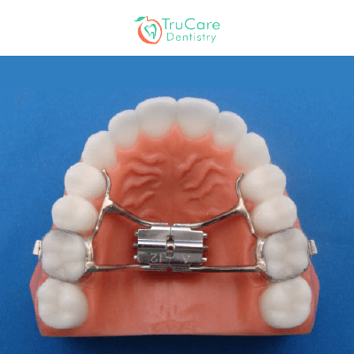 All about Palate Expanders – TruCare Dentistry