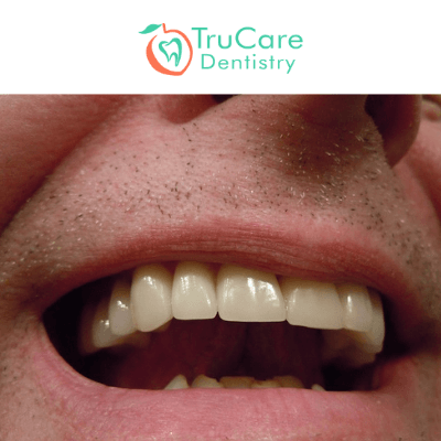 TruCare Dentistry Roswell - A dry socket is commonly seen after removing  the wisdom tooth. Read through this article to understand the cause, signs,  and treatment of a dry socket, usually after