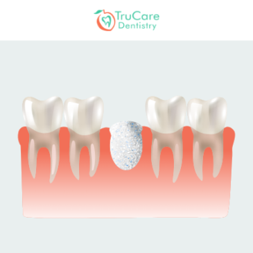 What are the different types of root canal treatment?, Dentist in Roswell,  GA, TruCare Dentistry Roswell