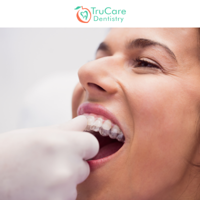 https://www.trucaredentistry.com/blog/wp-content/uploads/How-Often-Should-You-Change-Your-Invisalign-Trays.png