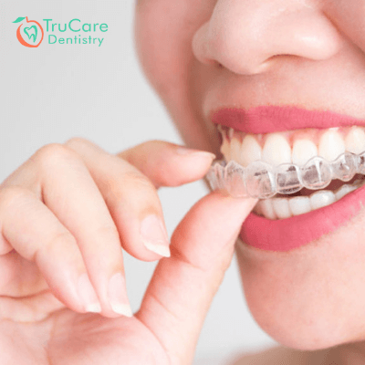 How long does Invisalign take to make your teeth beautiful? – TruCare  Dentistry