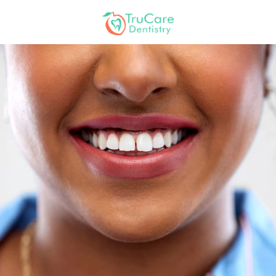 Everything You Need to Know about Craze Lines on Front Teeth, Dentist in  Roswell, GA, TruCare Dentistry Roswell