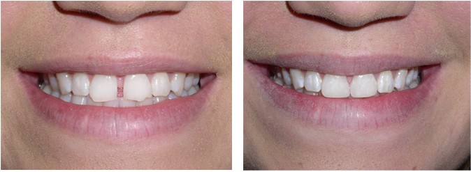 Dental Bonding Cost - Cosmetic Bonding Treatment