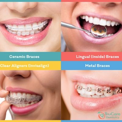 Ceramic/clear braces or metal braces – what are the differences?