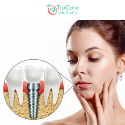 TruCare Dentistry Roswell - A dry socket is commonly seen after
