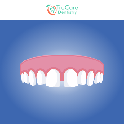 Can Fillings Look Like Your Natural Teeth? - TruCare Dentistry