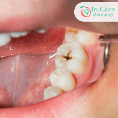 https://www.trucaredentistry.com/blog/wp-content/uploads/Why-do-I-get-cavities-despite-brushing-and-flossing-my-teeth-twice-a-day.png