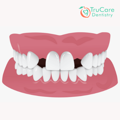 Are You Worried About A Gap Between Teeth Here S A List Of Best Treatment Options Trucare Dentistry Roswell