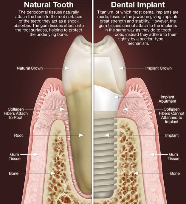 Implant Dentistry Roswell GA